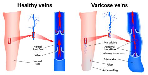11 Essential Differences: Varicose Vs. Regular Veins Explained