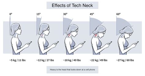 11 Essential Tips to Alleviate Text Neck Syndrome Today