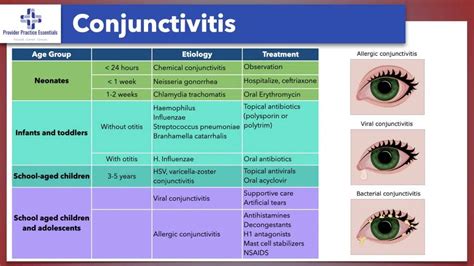 11 Holistic Methods to Alleviate Unilateral Conjunctivitis Effectively