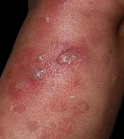 11 Methods for Alleviating Vesicular Dermatosis & Epidermal Ruptures