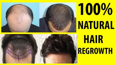 11 Proven Methods to Accelerate Male Hair Regrowth Naturally.