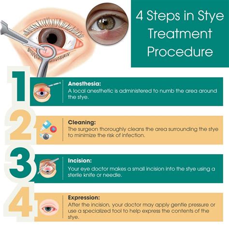 11 Proven Methods to Alleviate Styes: A Comprehensive Guide.
