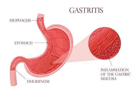 12 Decoding Gastritis & Acid Reflux: Symptoms, Causes & Relief.