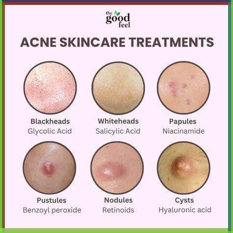 12 Effective Methods to Make Acne Signs Disappear Fast