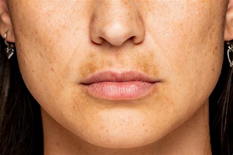 12 Proven Methods to Eradicate Facial Hyperpigmentation Effectively.