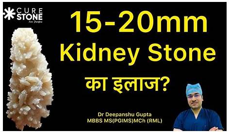 15 Mm Kidney Stone How To Remove Breaking 3 8 s In Ureter Specialists In