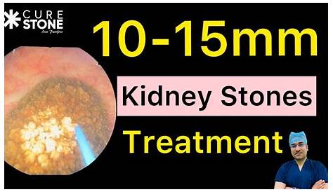 15 Mm Kidney Stone Treatment Kideny Treatement By Dr Sarpal Drsarpal
