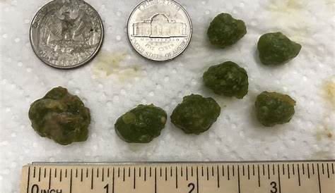 Liver and Gallbladder Biliary Stones. (Solidified bile