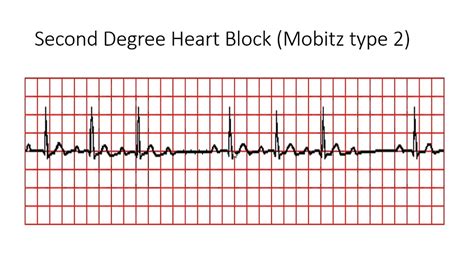 2nd degree heart block type 2 mobitz ii