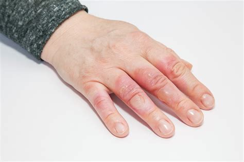 How to Treat and Soothe a 2nd Degree Sunburn for Faster Relief