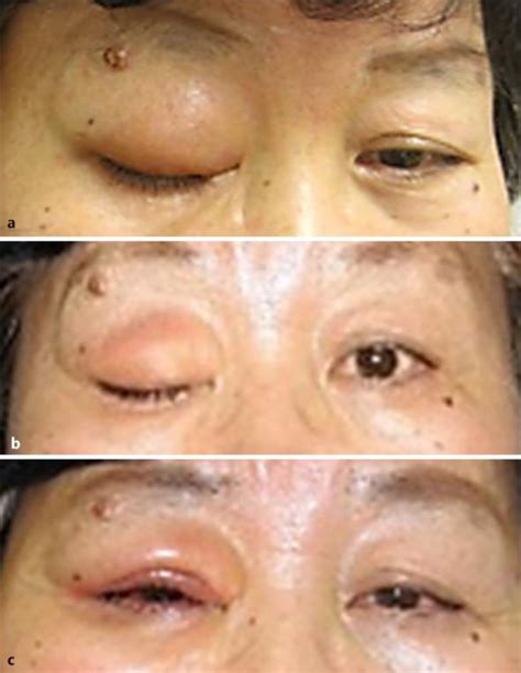 Clear Vision Triumphs: Unpacking the Transformative Results of 3 Months Post-Vitrectomy Journey