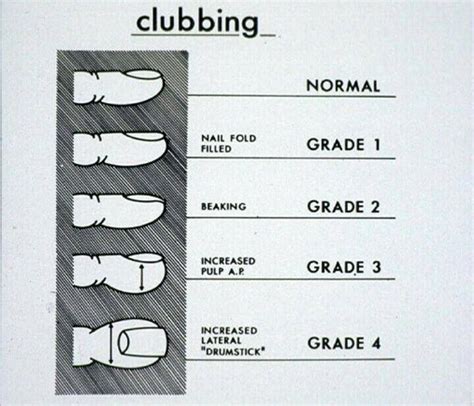 3. Clubbing