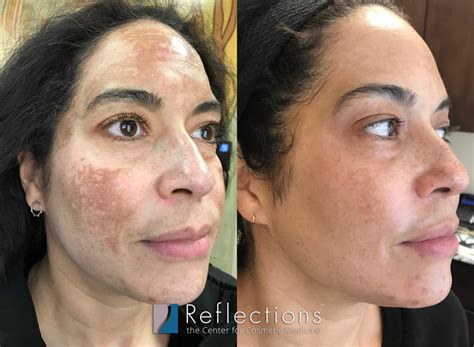 3. Professional Procedures for Stubborn Melasma