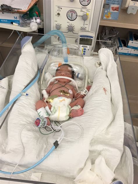 What Happens When a 34 Week Fetus is Born: Understanding Preterm Birth Risks and Outcomes