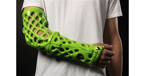 Revolutionize Healing with 3D Printed Cast Technology