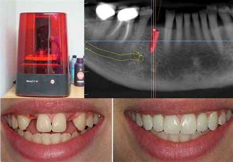 3d Printing Dental Implants