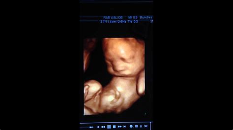 3D Sonogram At 27 Weeks
