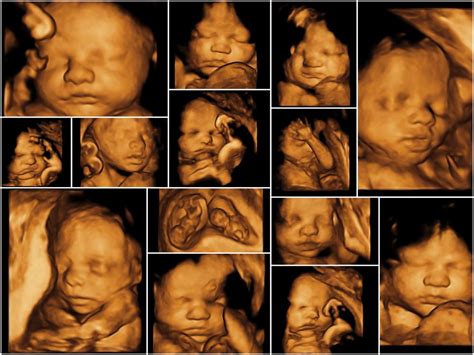 3d sonogram pregnancy