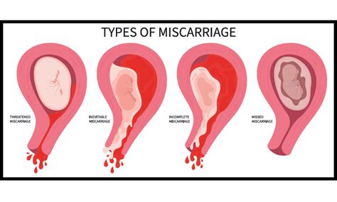 Tragic Loss: Understanding the Devastating Reality of Miscarrying a 4 Month Fetus