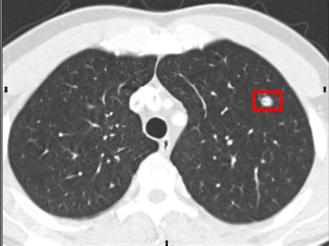 4 mm Lung Nodule