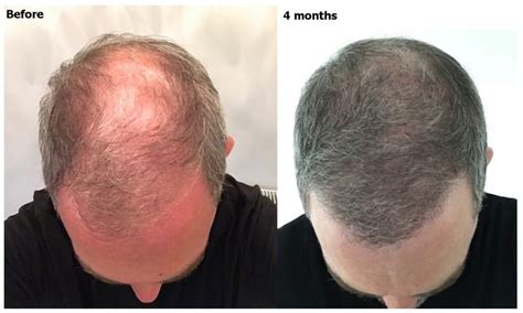 Revolutionize Weight Loss with 4 Month Injections Explained