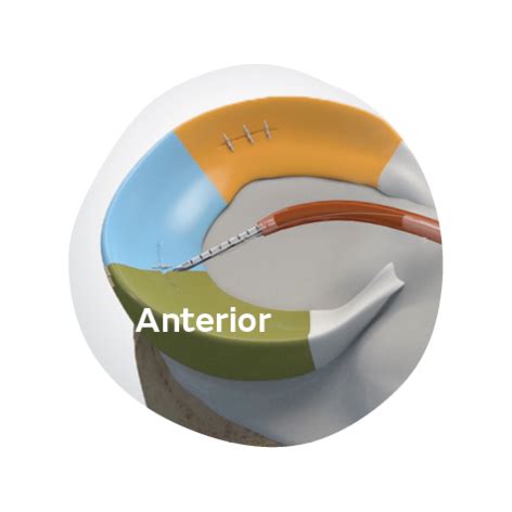 4. Opt for a fast fix