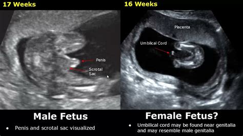 4d ultrasound determine babys gender