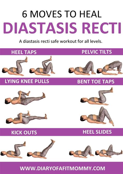 Exercises to Prevent Diastasis Recti