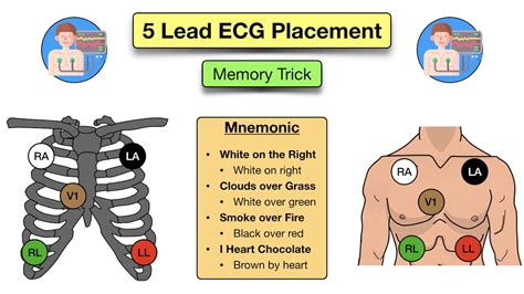 Mastering 5 Lead ECG Placement for Accurate Cardiac Monitoring