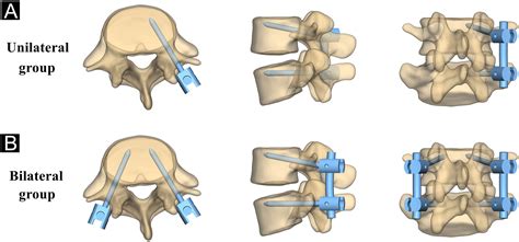 5 penetration double fixation
