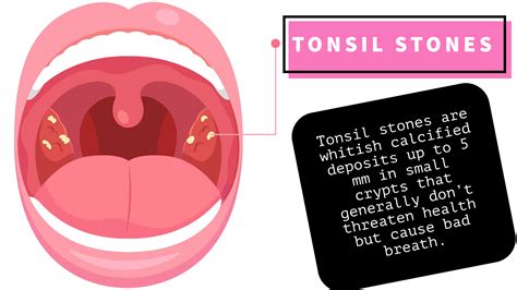 5 train tonsil