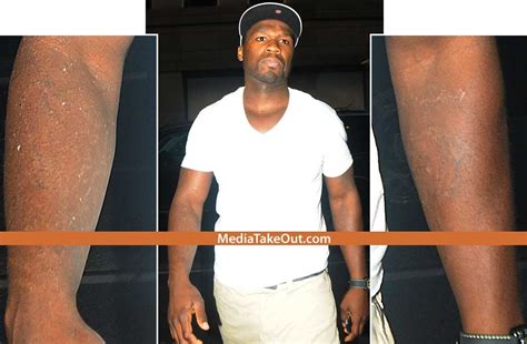 50 Cent had all the tattoos on his arm removed. What his