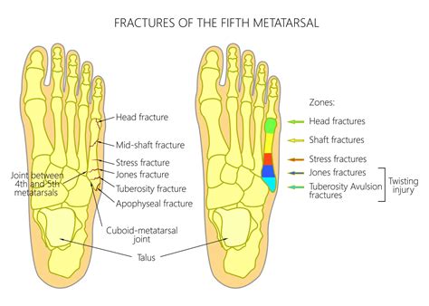 Understanding and Managing a 5th Metatarsal Break: Causes, Symptoms, and Effective Treatment Options