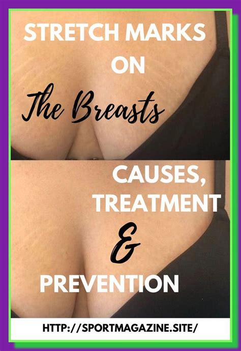 6 Essential Tips for Treating Stretch Marks on Breasts