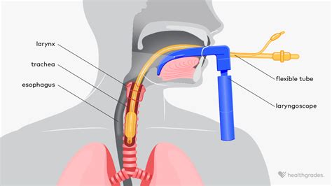 6. Intubation Explained: Key Procedures and Potential Risks Unveiled