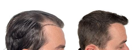 Dr. Hasson /4,303 Grafts/ FUE/ 1 Session/ 9 months postop Results