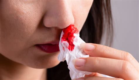7 Effective Methods for Treating Fatigue-Induced Nosebleeds