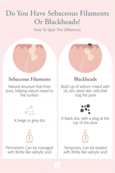7 Essential Insights: Sebaceous Filaments vs. Blackheads Explained
