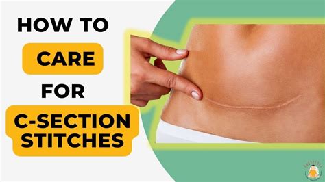 7 Essential Tips for Treating Infected Caesarean Stitches Effectively