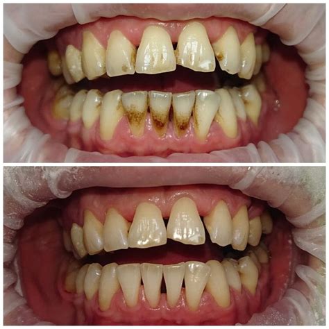 7 Proven Methods to Remove Black Tartar Effectively