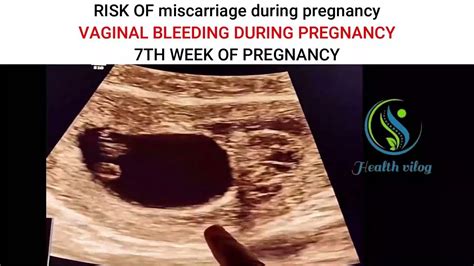 Understanding 7th Week Miscarriage: Causes, Symptoms, and Support