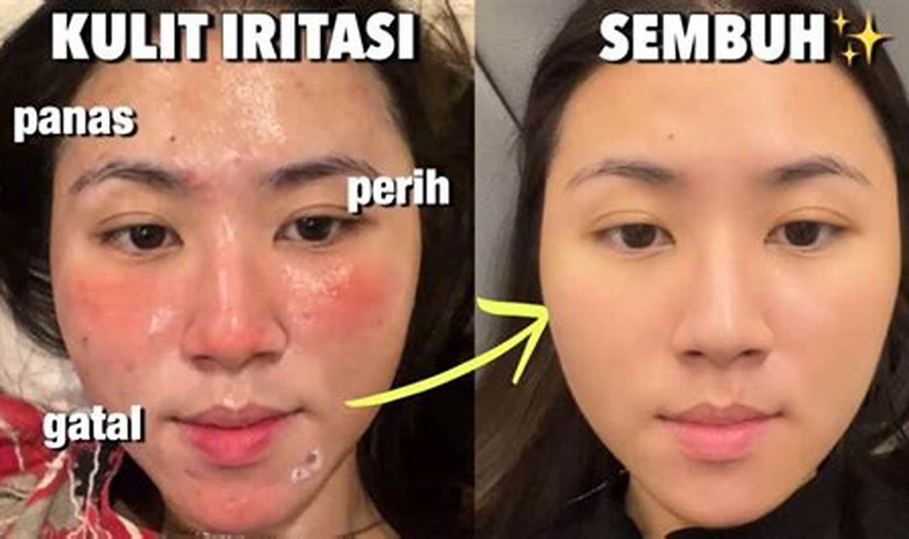 8 penyebab kulit wajah memerah dan cara efektif
