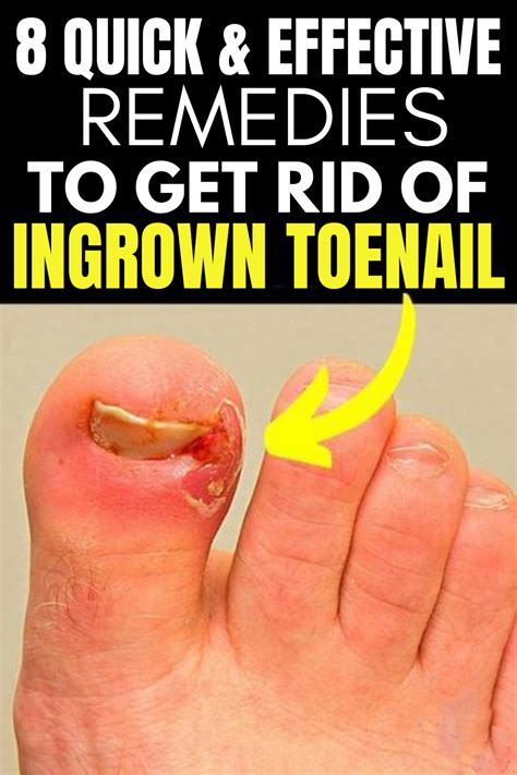 8 Effective Methods to Alleviate Ingrown Toenail Pain Naturally