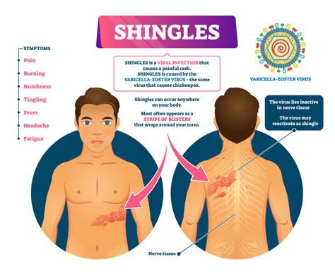8 Essential Signs of Shingles Recovery You Should Recognize
