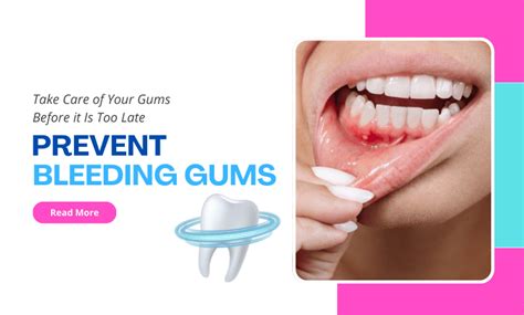 8 Essential Tips to Prevent Frequent Bleeding Gums Today