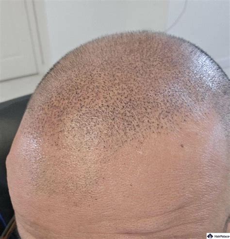 8 scalp micropigmentation regrets and how to avoid them