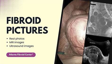 9 Cm Fibroid In Uterus Pictures Pregnancy
