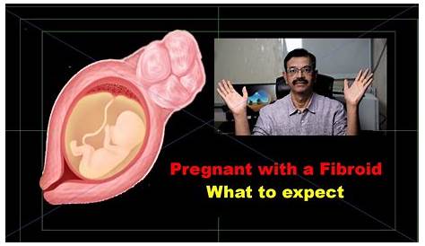 9 Cm Fibroid Pregnancy Laparoscopic Myomectomy GENESYS FERTILITY