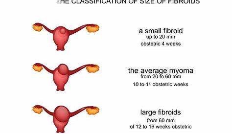 9 Cm Fibroid Laparoscopic Myomectomy 5 GENESYS FERTILITY