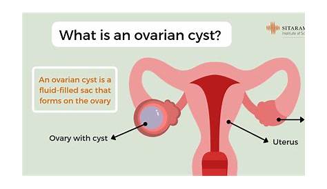 9 Cm Ovarian Cyst Removal